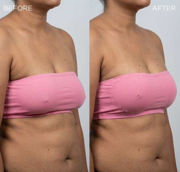 Breast Lift.png